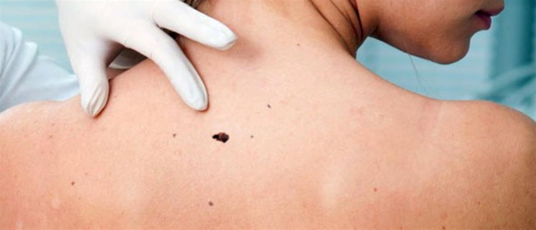 Καρκίνος του δέρματος: Έγκαιρη διάγνωση για επιτυχημένη αντιμετώπιση