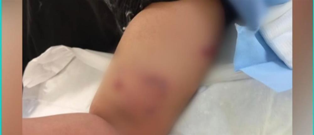 Σοκ στο Πέραμα: Σκύλος επιτέθηκε και τραυμάτισε 12χρονο έξω από σχολείο