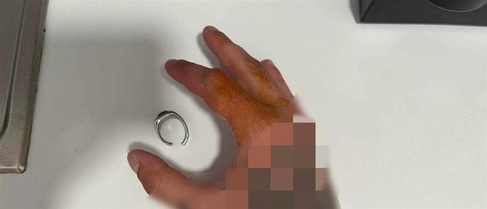 Δαχτυλίδι - Χαλκιδική Δαχτυλίδι - Χαλκιδική