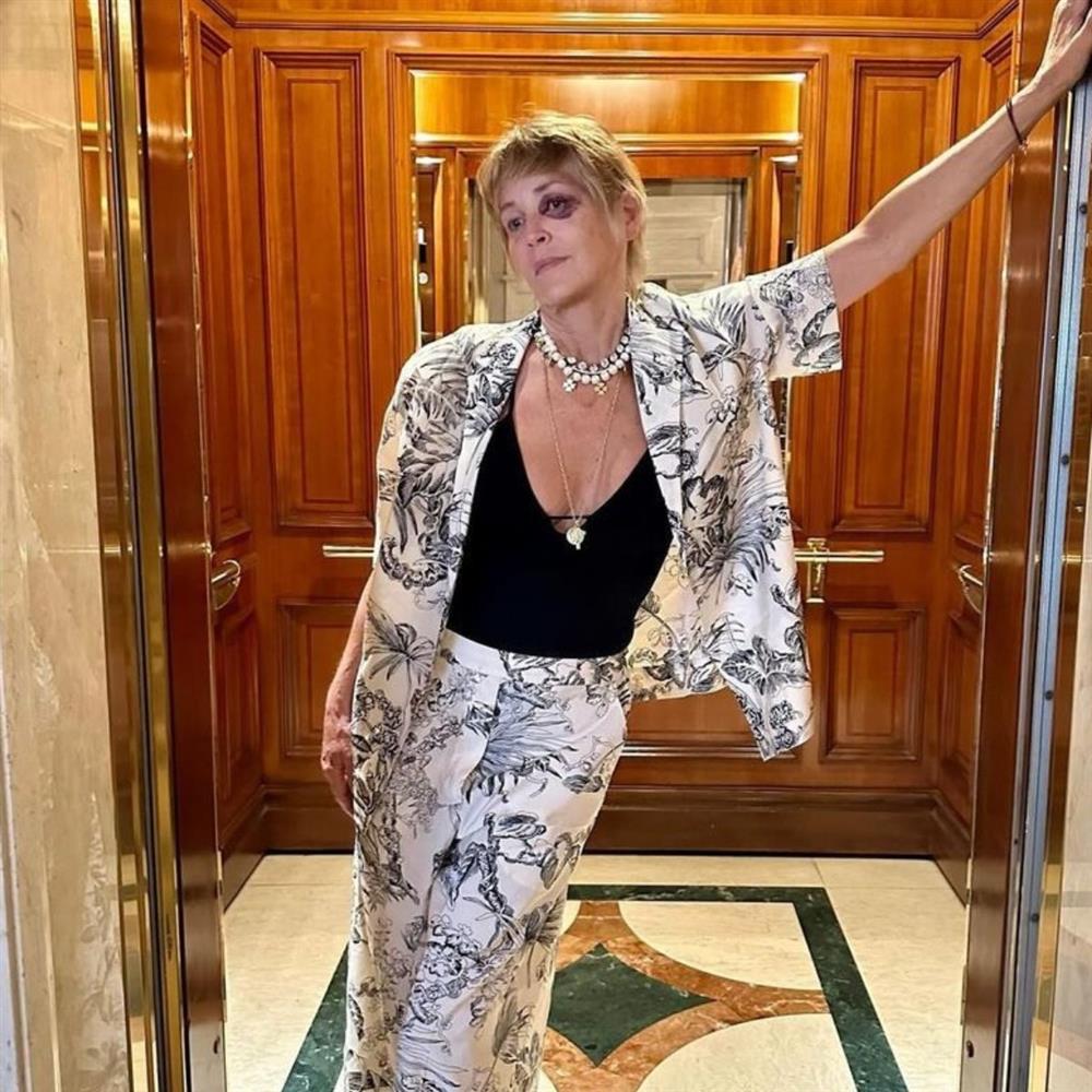 Σάρον Στόουν: Ξεκαθαρίζει για το μαυρισμένο της μάτι - "Κανείς δεν μου έκανε τίποτα"