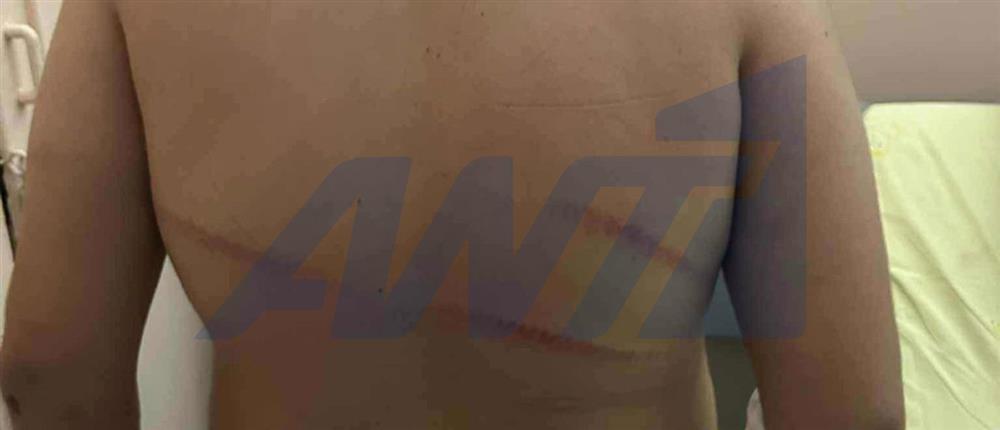 Θεσσαλονίκη - 13χρονος - ξυλοδαρμος