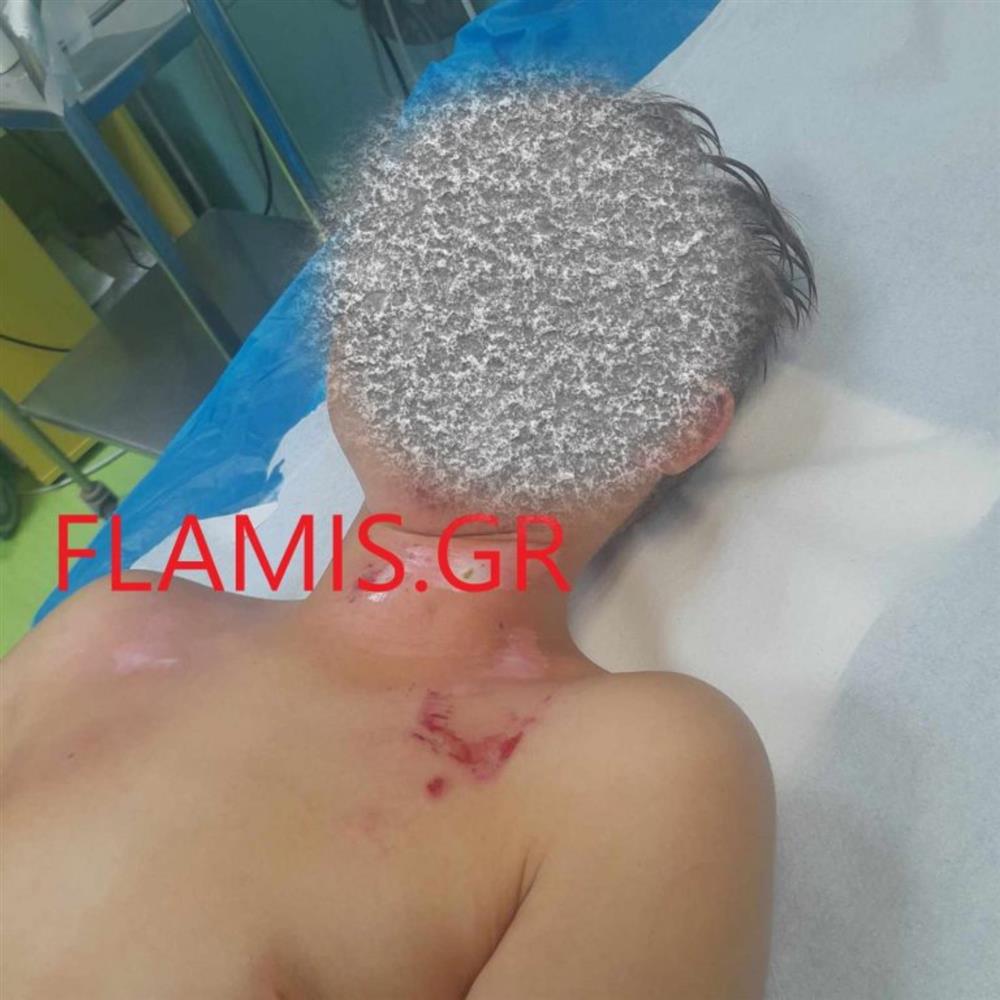 Πάτρα - Βεγγαλικά - Σχολείο - Τραυματίας μαθητής Πάτρα - Βεγγαλικά - Σχολείο - Τραυματίας μαθητής