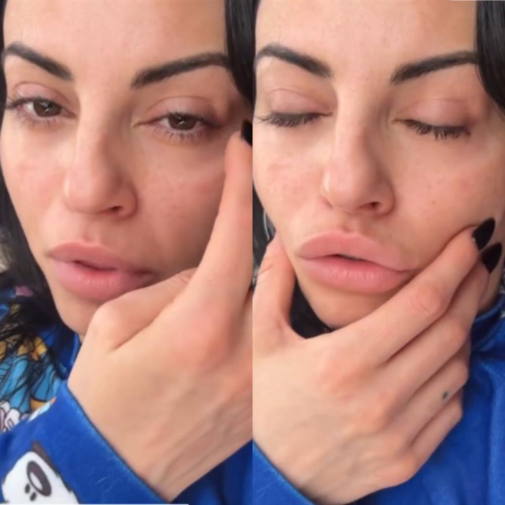 Δήμητρα Αλεξανδράκη: Πρήστηκε όλο της το πρόσωπο - Έπαθε αλλεργική αντίδραση από sushi (Βίντεο)