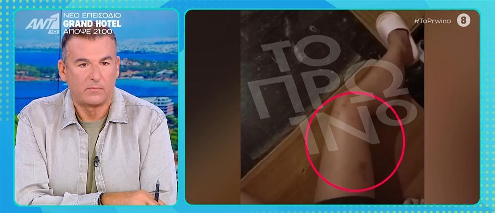 "Γιατί με χτύπησες; Πονάω" – Καταγγελία 19χρονης για ξυλοδαρμό από πρώην σύντροφό της