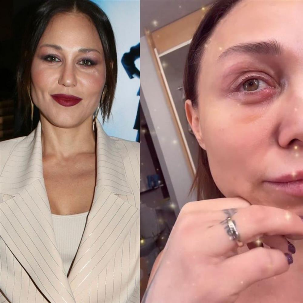 Πηνελόπη Αναστασοπούλου: Εμφανίστηκε με πρησμένο μάτι! "Όποιος με καταράστηκε, συγχαρητήρια τα κατάφερε" (Βίντεο)