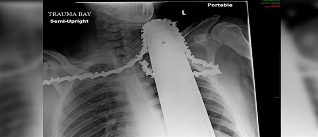 Αλυσοπρίονο καρφώθηκε στον λαιμό ξυλοκόπου!