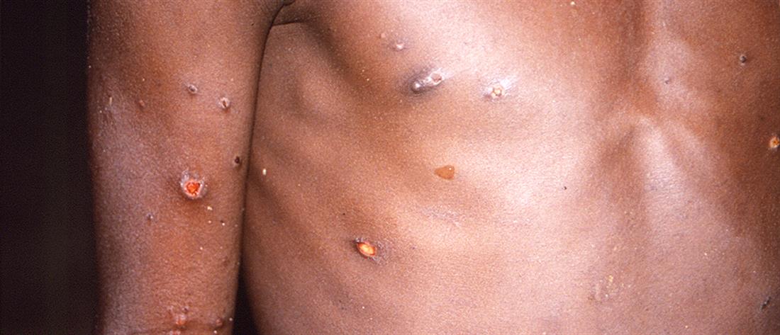 AP - Ευλογιά των πιθήκων