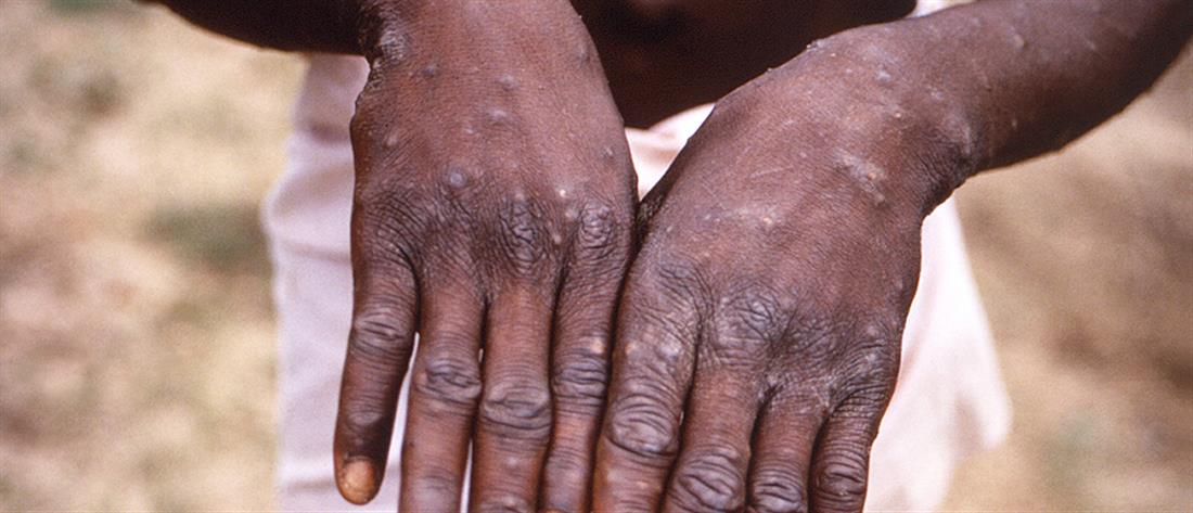 AP - Ευλογιά των πιθήκων